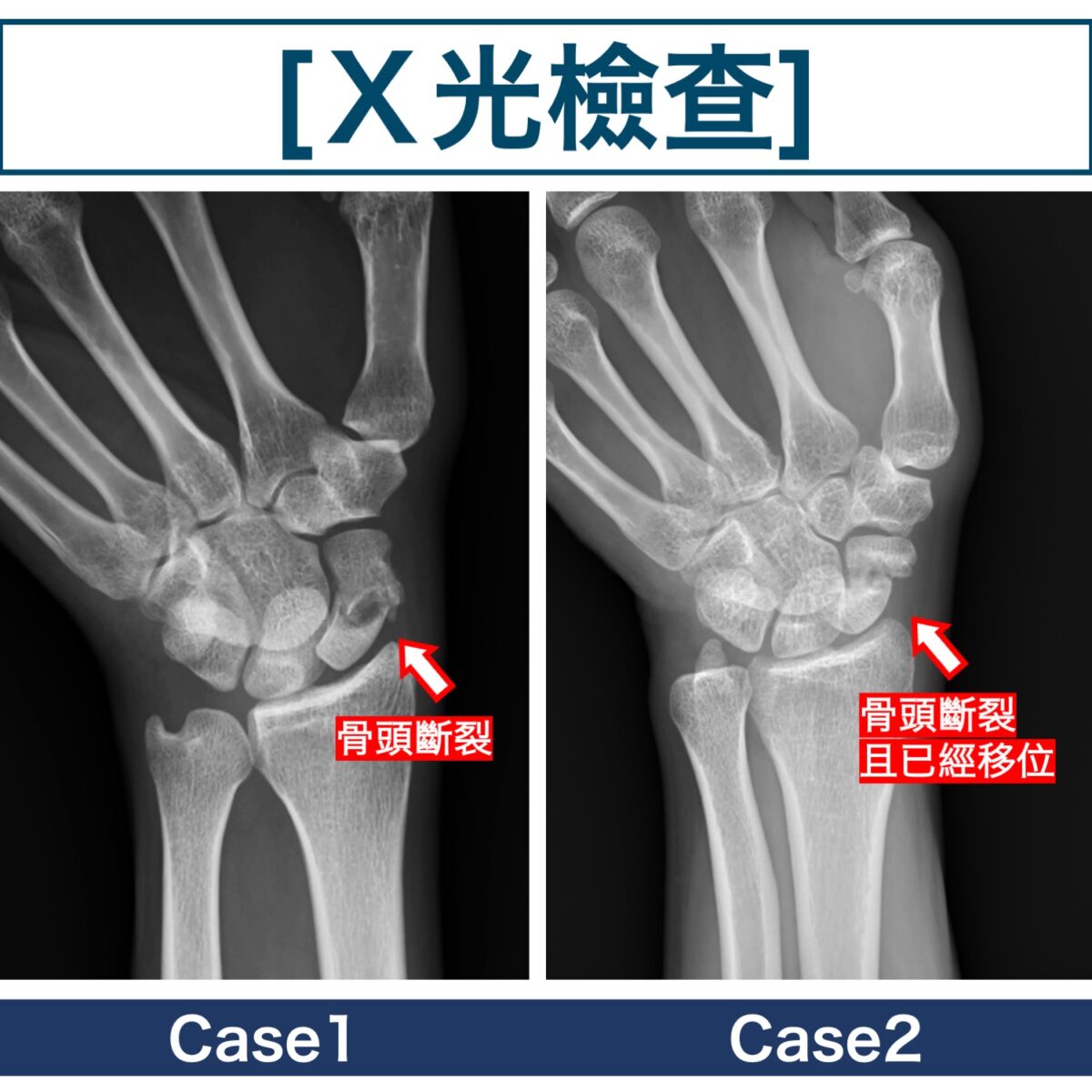 骨頭移位X光