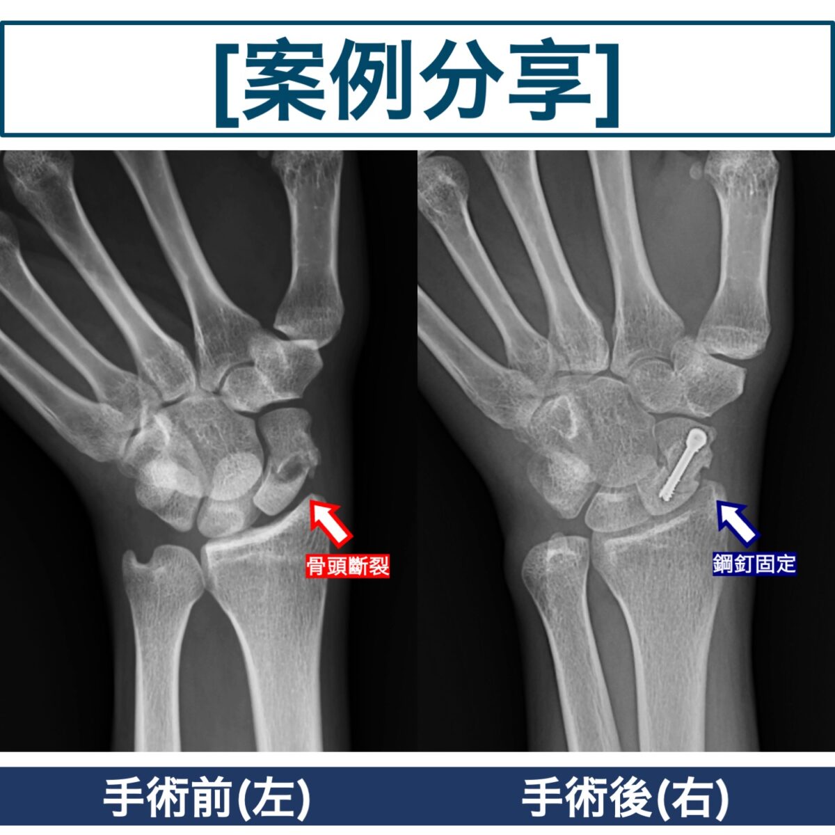 骨頭移位案例